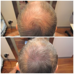 PRP therapy for hair loss