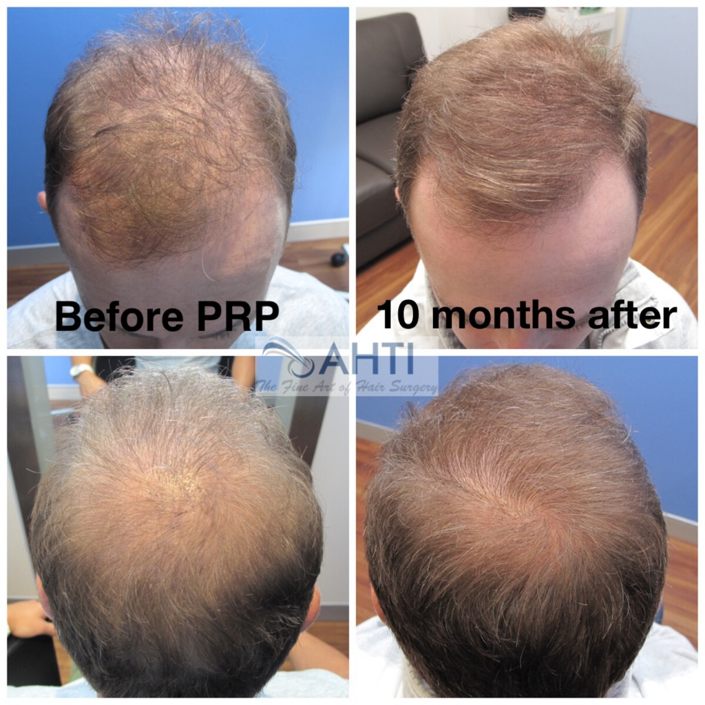 PRP for hair loss